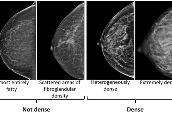 Mammogram centers must now inform women about their breast density. Here’s how it could affect you